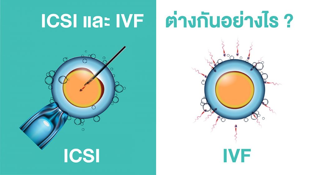 ICSI-IVF